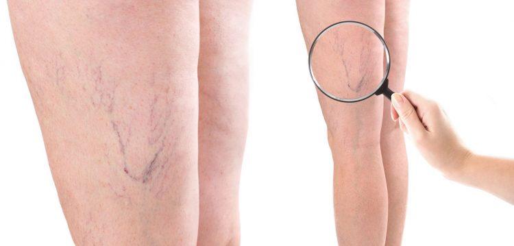 Varicose Veins: Things That You Need to Know